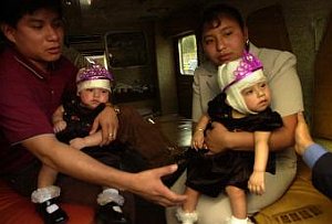 Dvojičky, ktoré sa narodili so zrastenými hlavami, oslávili 10. narodeniny