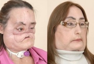 Žena s transplantovanou tvárou sa rozviedla s mužom, ktorý ju znetvoril